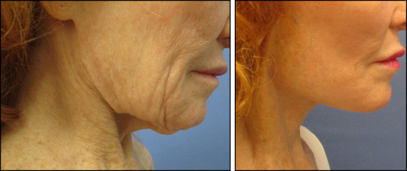 facelift